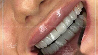 چطور کامپوزیت دندان در کمتر از یک جلسه لبخندتان را تغییر میدهد؟