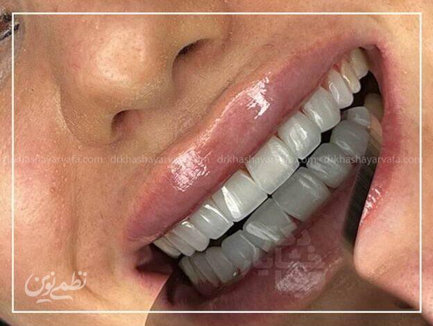 چطور کامپوزیت دندان در کمتر از یک جلسه لبخندتان را تغییر میدهد؟