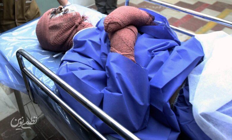 سوختگی - اسیدپاشی