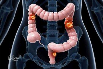 علائم سرطان روده چیست؟