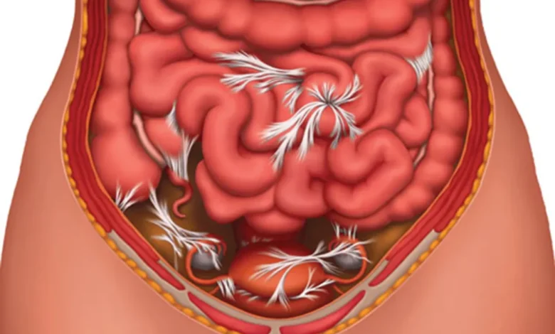 چسبندگی روده