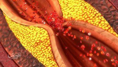 Athersclerosis