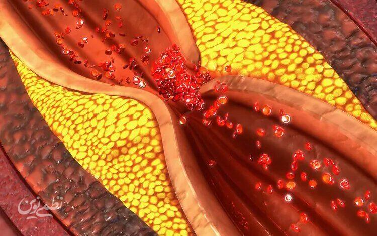 Athersclerosis