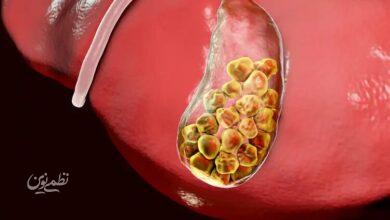 gallstone