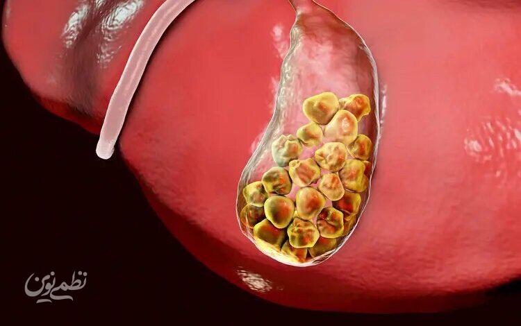 gallstone