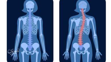 scoliosis