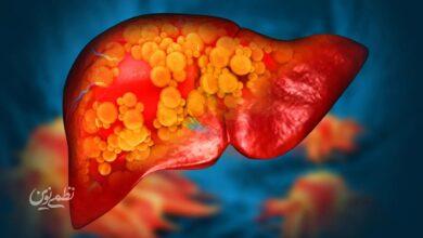 fatty liver