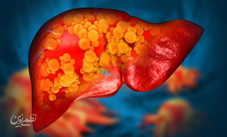 fatty liver