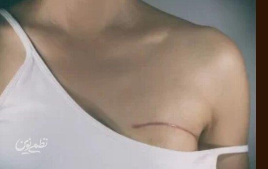 کاهش وزن چه ارتباطی با سرطان سینه دارد؟