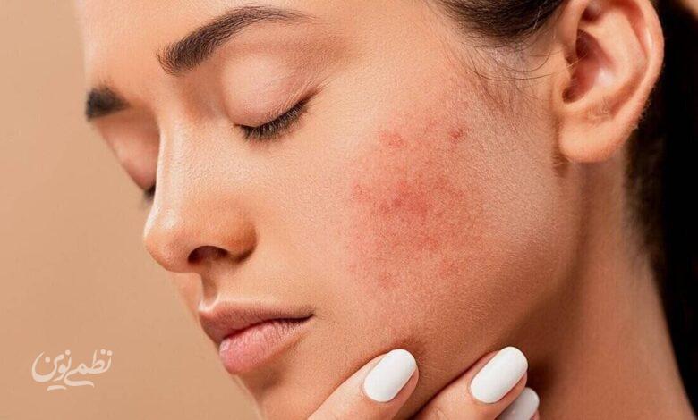 برای رفع خشکی پوست چه خوراکیهایی بخوریم؟