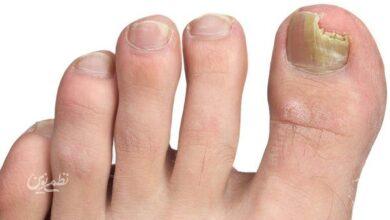nail infection