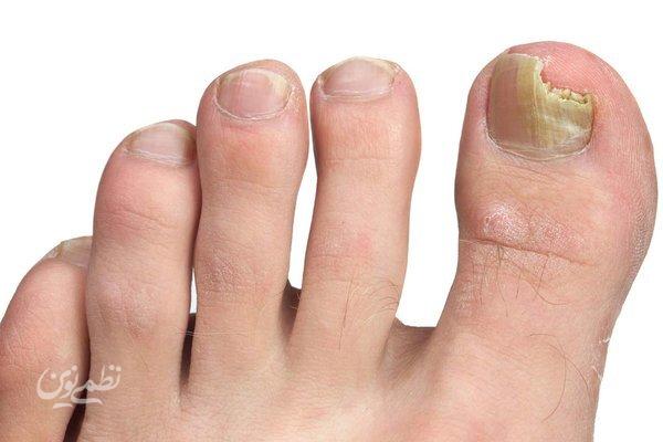 nail infection
