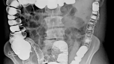 barium enema