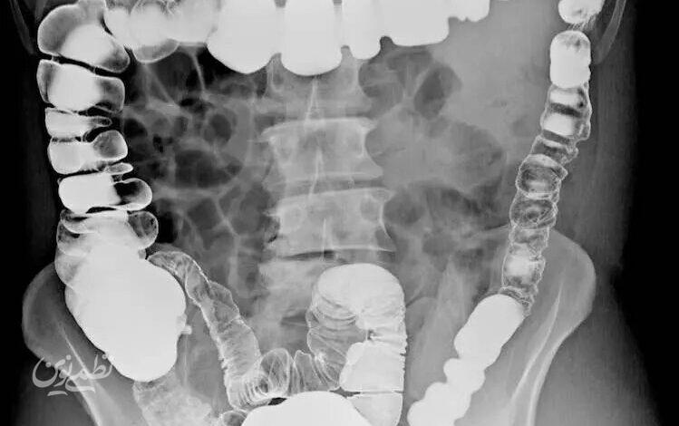 barium enema
