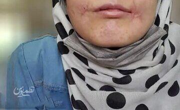 مرد مشهدی لبهای زن ۱۸ سالهاش را دوخت / فائزه به کلانتری پناه برد/ عکس