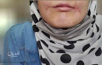 مرد مشهدی لبهای زن ۱۸ سالهاش را دوخت / فائزه به کلانتری پناه برد/ عکس