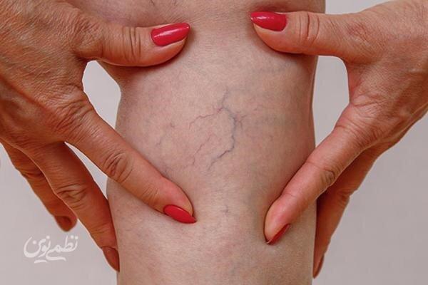 راهکارهایی برای پیشگیری از واریس که باید بدانید