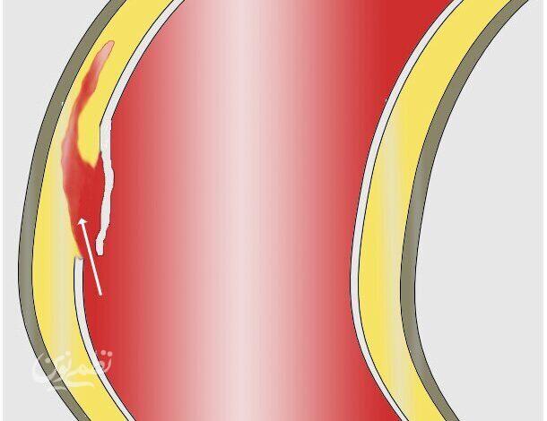 Aorta