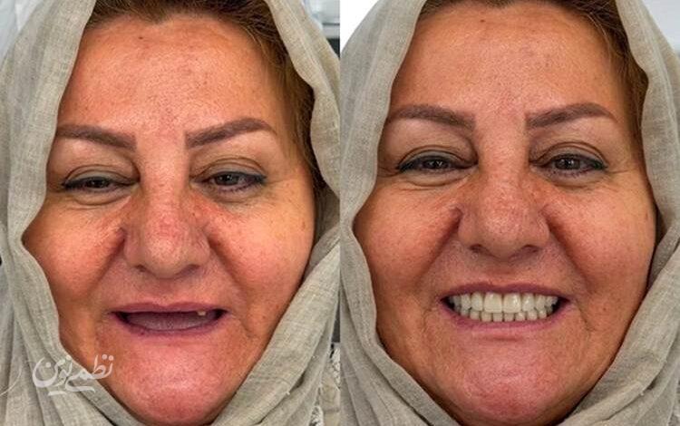 اوردنچر فول