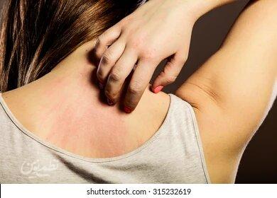 خارش پوست میتواند نشانه سرطان باشد؟