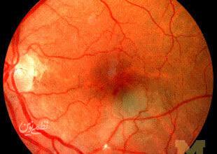 retina