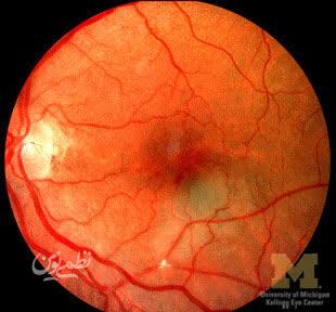 retina