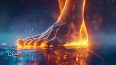 neuropathy